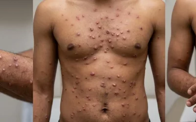 Mpox no Brasil: tudo que você precisa saber para se proteger